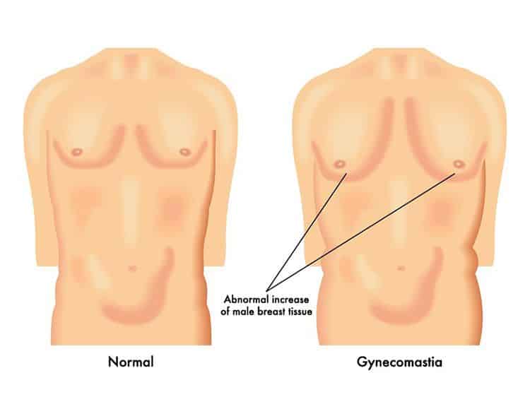 gynecomastia gynecomastia