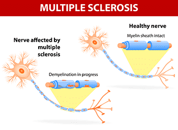 Best B12 Supplement The Ultimate Guide MS