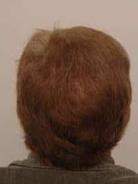 procerin-after-picture-1