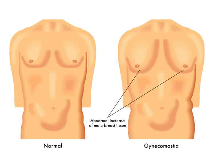 prolactin sperm gyno