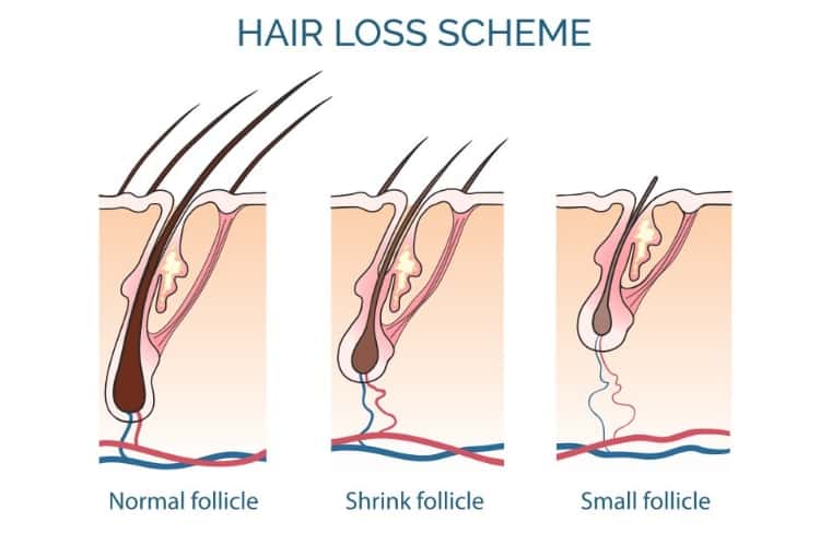 Hair loss scheme Hair loss scheme