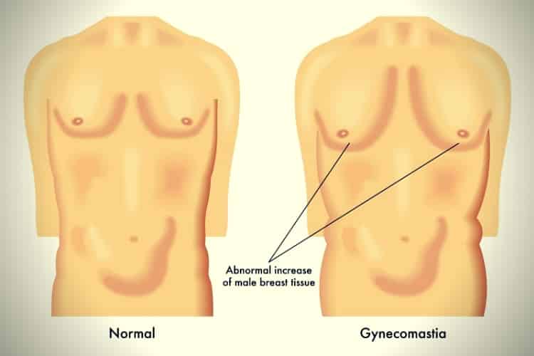 Human Gynecomastia scheme Human Gynecomastia scheme