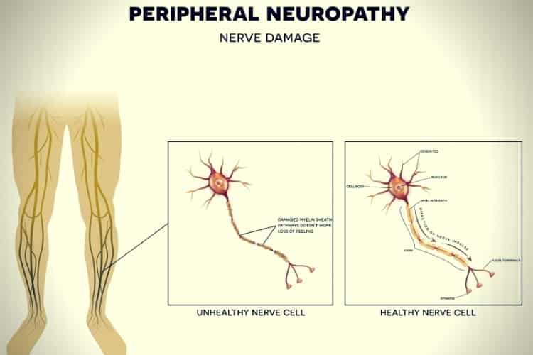 Neuropathy, nerve damage