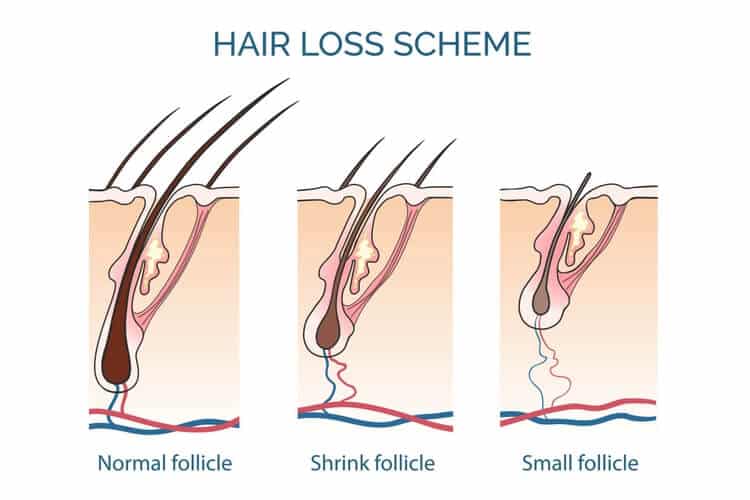 hair loss scheme hair loss scheme