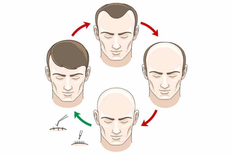 stages of hair loss stages of hair loss