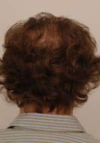 procerin-after-picture-2