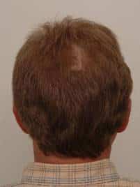 procerin-before-picture-1
