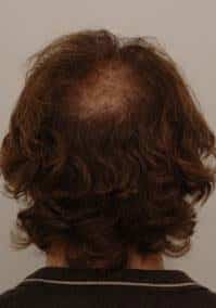 procerin-before-picture-2