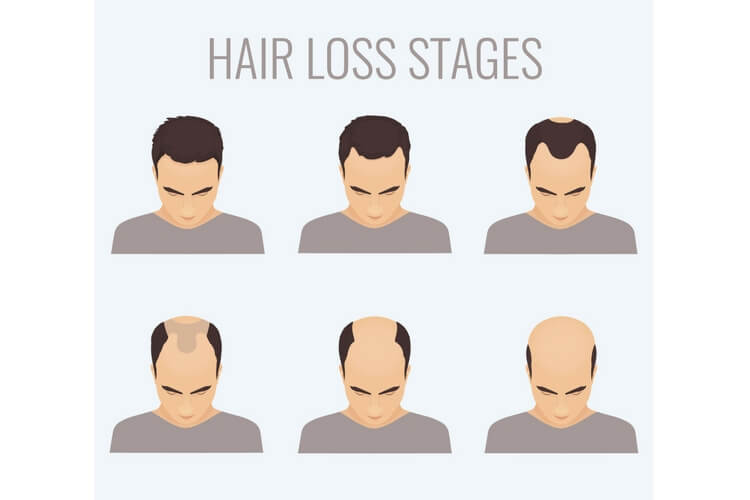 stages